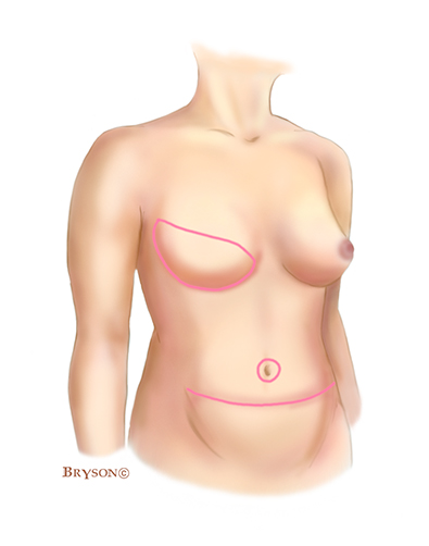 Image of delayed DIEP breast reconstruction (left breast) and delayed