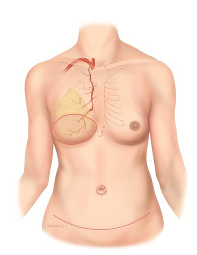 Not Putting on a Shirt - If you're facing mastectomy & considering going  flat, you should know that there are many ways to produce an aesthetic flat  closure (as defined by the