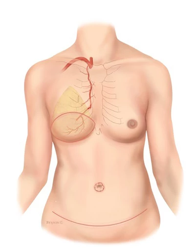 Breast Reconstruction