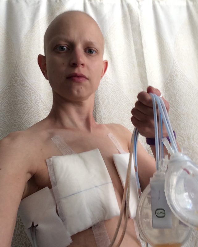 Katie Dunn Cancer Treatment